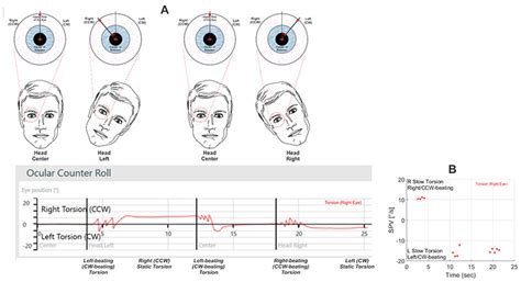 torsion eye test|torsional eye movements examples.